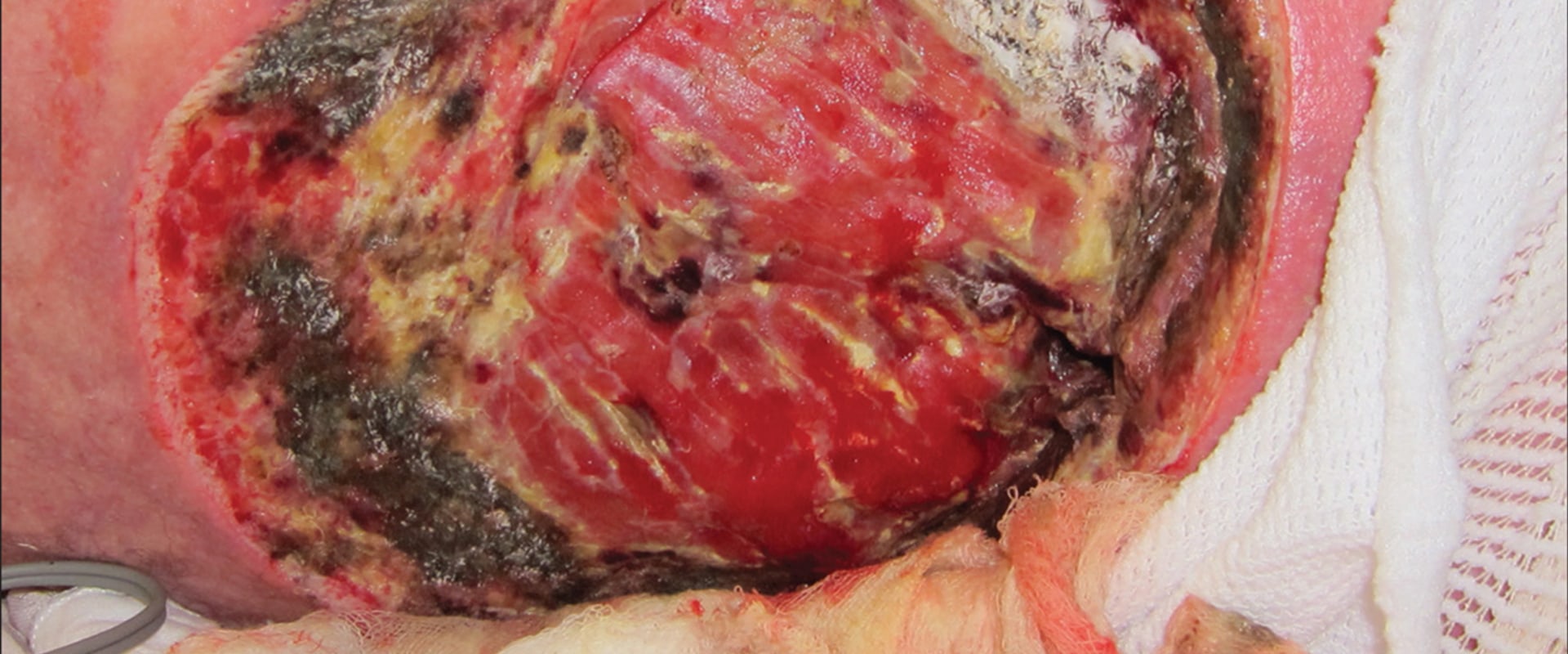 Fungal Diseases - A Comprehensive Overview